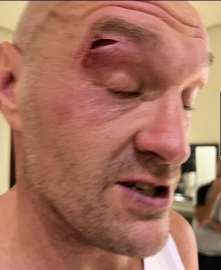 Tyson Fury Cut Badly, Oleksandr Usyk Fight Postponed